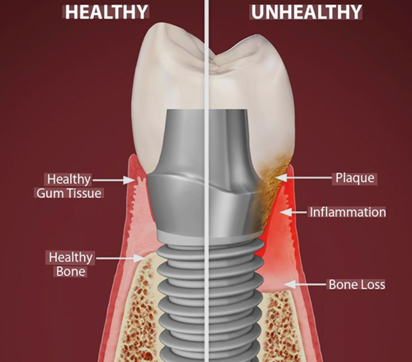 Illustration of an implant in health and with peri-implantitis